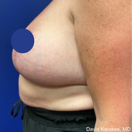 Breast Lift Before & After Patient #4541