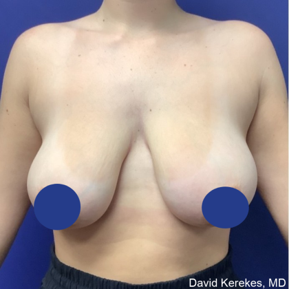 Breast Reduction Before & After Patient #4555