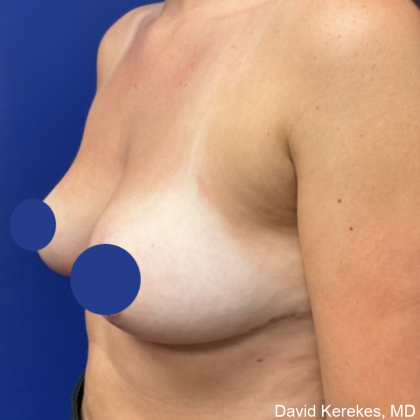 Breast Reduction Before & After Patient #4555