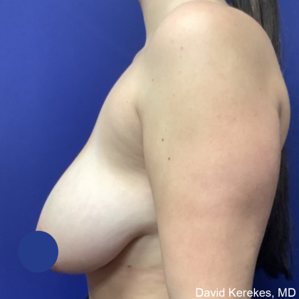 Breast Reduction Before & After Patient #4555