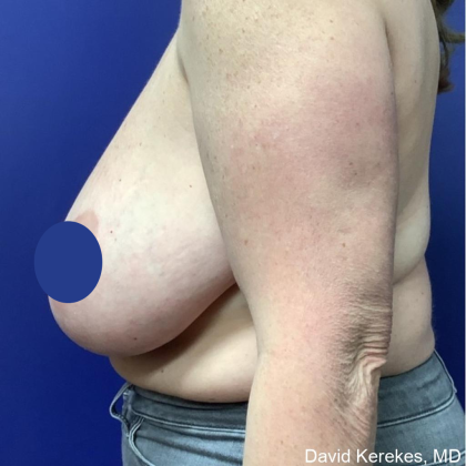 Breast Lift Before & After Patient #4541