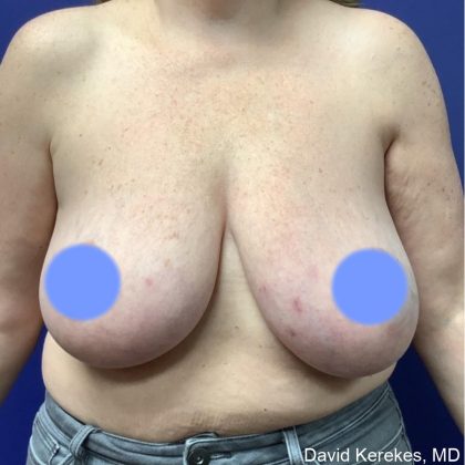 Breast Lift Before & After Patient #4541