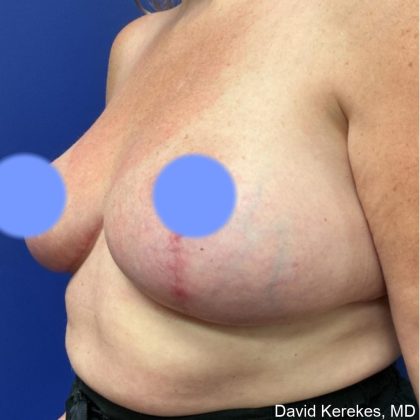 Breast Lift Before & After Patient #4541