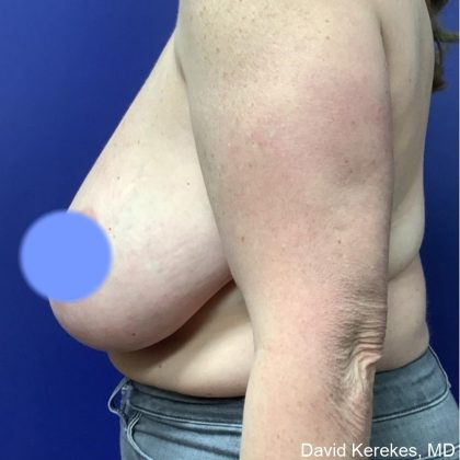 Breast Lift Before & After Patient #4541