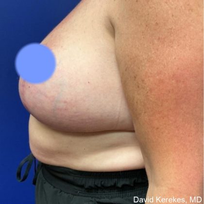 Breast Lift Before & After Patient #4541