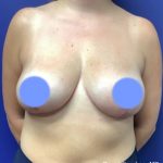Breast Reduction Before & After Patient #4417
