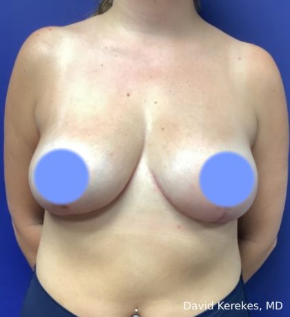 Breast Reduction Before & After Patient #4417