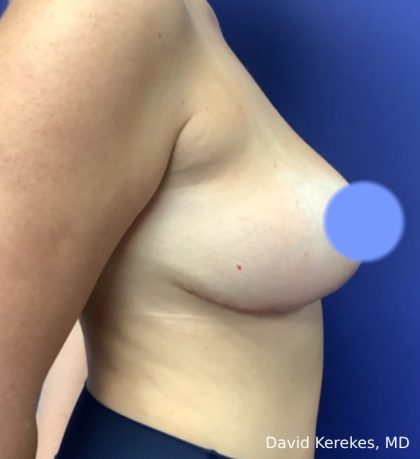 Breast Reduction Before & After Patient #4417
