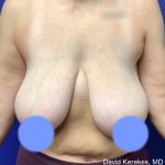 Breast Reduction Before & After Patient #4430