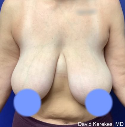 Breast Reduction Before & After Patient #4430