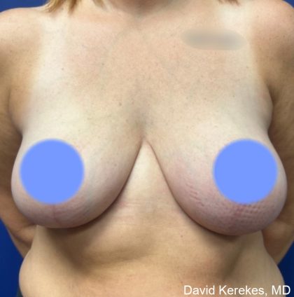Breast Reduction Before & After Patient #4430