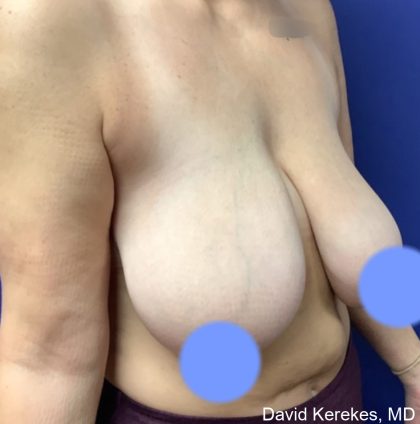 Breast Reduction Before & After Patient #4430