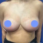 Breast Reduction Before & After Patient #4449