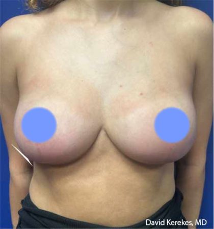Breast Reduction Before & After Patient #4449