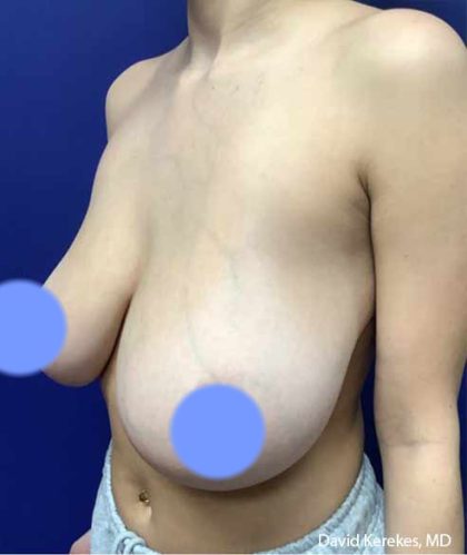Breast Reduction Before & After Patient #4449