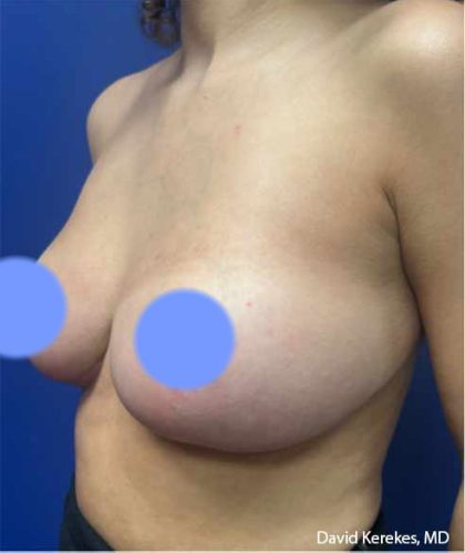 Breast Reduction Before & After Patient #4449