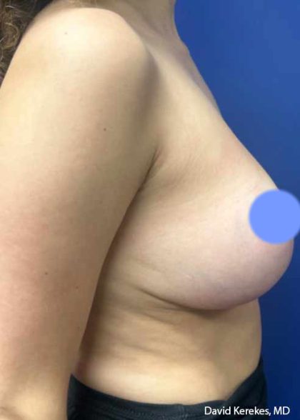 Breast Reduction Before & After Patient #4449