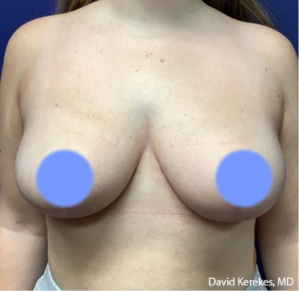 Breast Reduction Before & After Patient #4475