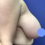 Breast Reduction Before & After Patient #4475