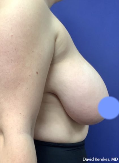 Breast Reduction Before & After Patient #4475