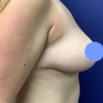 Breast Reduction Before & After Patient #4475