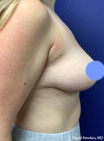 Breast Reduction Before & After Patient #4475