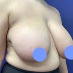Breast Reduction Before & After Patient #4475