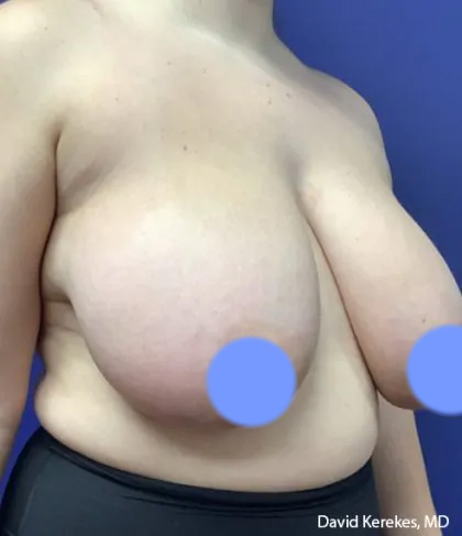 Breast Reduction Before & After Patient #4475