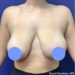 Breast Reduction Before & After Patient #4555