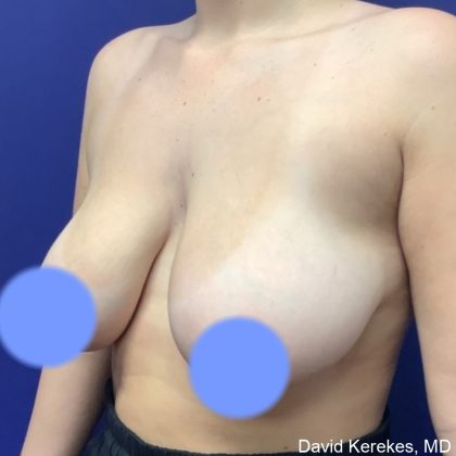 Breast Reduction Before & After Patient #4555