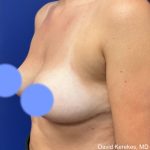 Breast Reduction Before & After Patient #4555