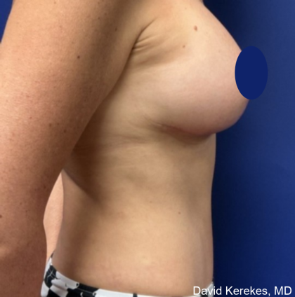Mommy Makeover Before & After Patient #4567