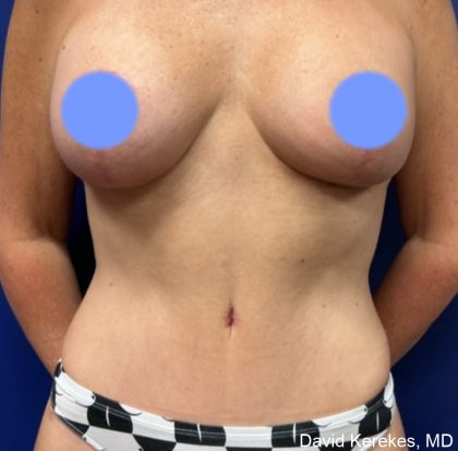 Mommy Makeover Before & After Patient #4567