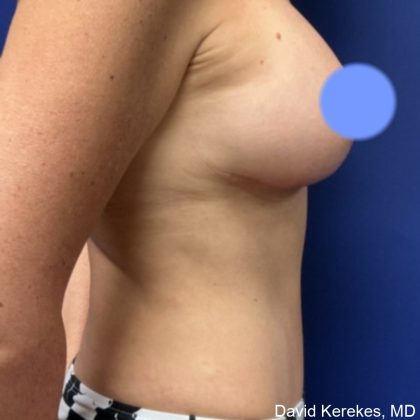 Mommy Makeover Before & After Patient #4567