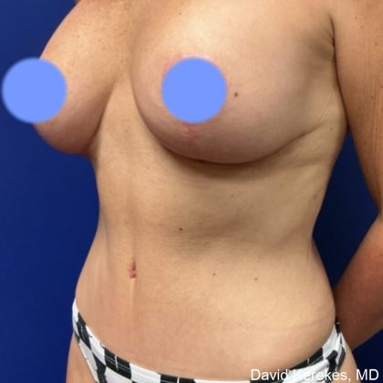 Mommy Makeover Before & After Patient #4567