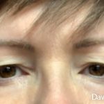 Eye Lift Before & After Patient #4829