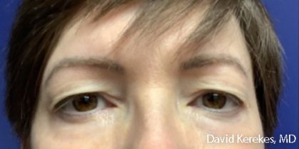 Eye Lift Before & After Patient #4829