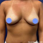 Breast Augmentation Before & After Patient #4847