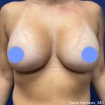 Breast Augmentation Before & After Patient #4847