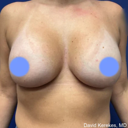 Breast Augmentation Before & After Patient #4847