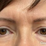 Eye Lift Before & After Patient #4829