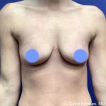 Breast Augmentation Before & After Patient #4848