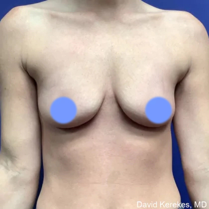 Breast Augmentation Before & After Patient #4848