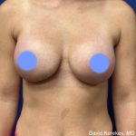 Breast Augmentation Before & After Patient #4848