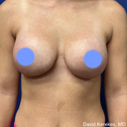 Breast Augmentation Before & After Patient #4848