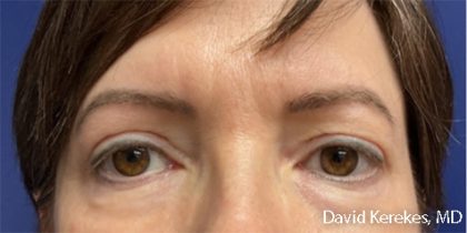 Eye Lift Before & After Patient #4829