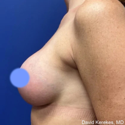 Breast Augmentation Before & After Patient #4848