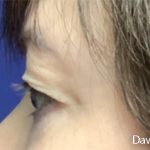 Eye Lift Before & After Patient #4829