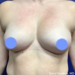 Breast Augmentation Before & After Patient #4849