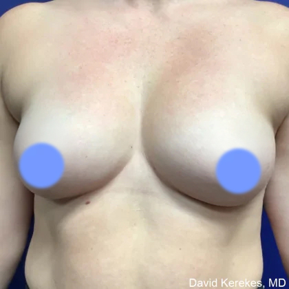 Breast Augmentation Before & After Patient #4849